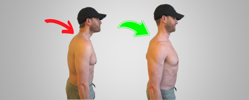 forward head posture before and after